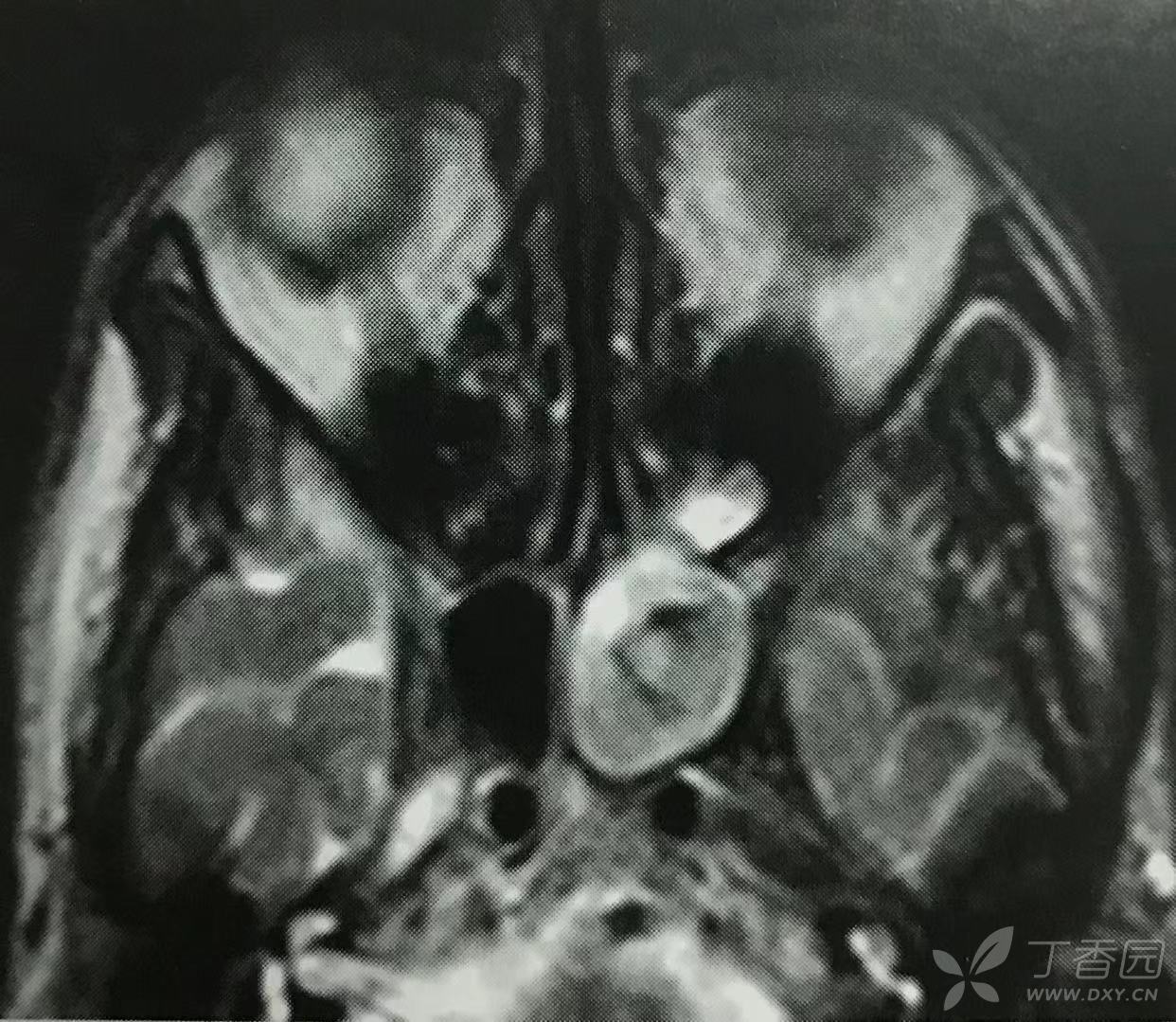 是ct的补充;真菌性鼻窦炎,mri显示钙化能力有限,需要结合ct检查,但是
