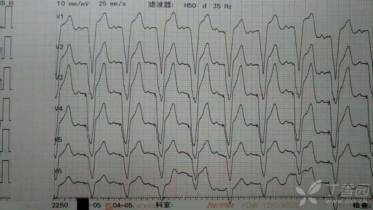 大部分导联全是宽大qs波,如何诊断?意义?