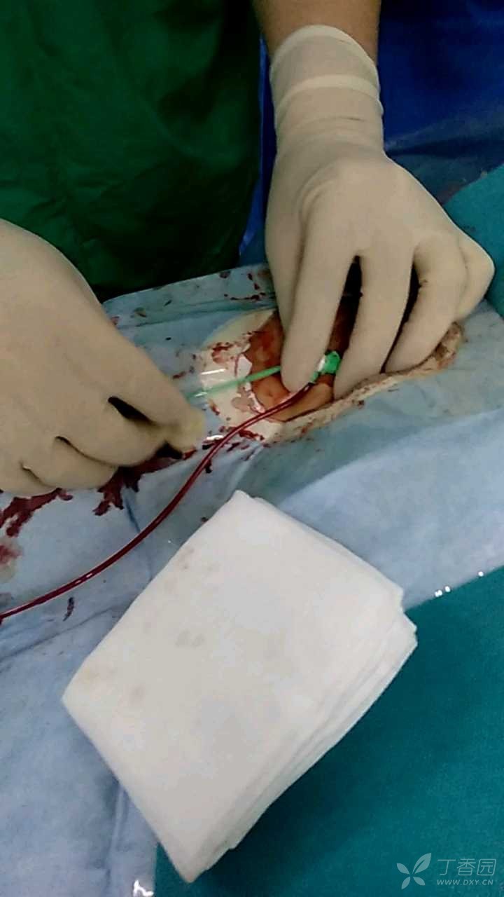 冠脉介入之股动脉缝合器详解(小心有血)