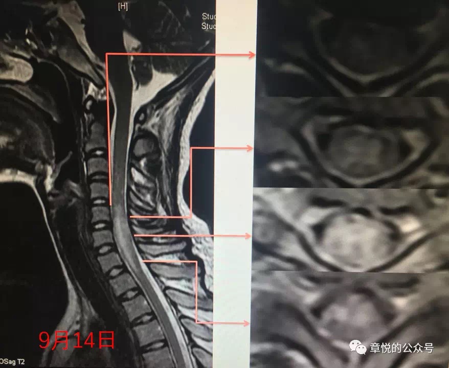 三个脊髓前动脉综合征案例