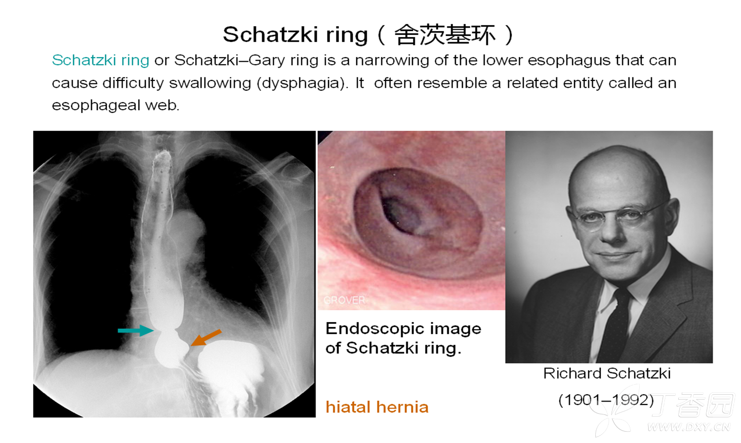 Schatzki Ring 舍茨基环 影像医学和核医学讨论版 丁香园论坛