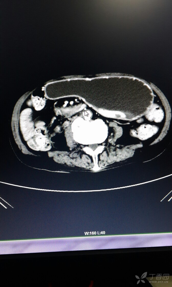 十二指肠憩室CT图片