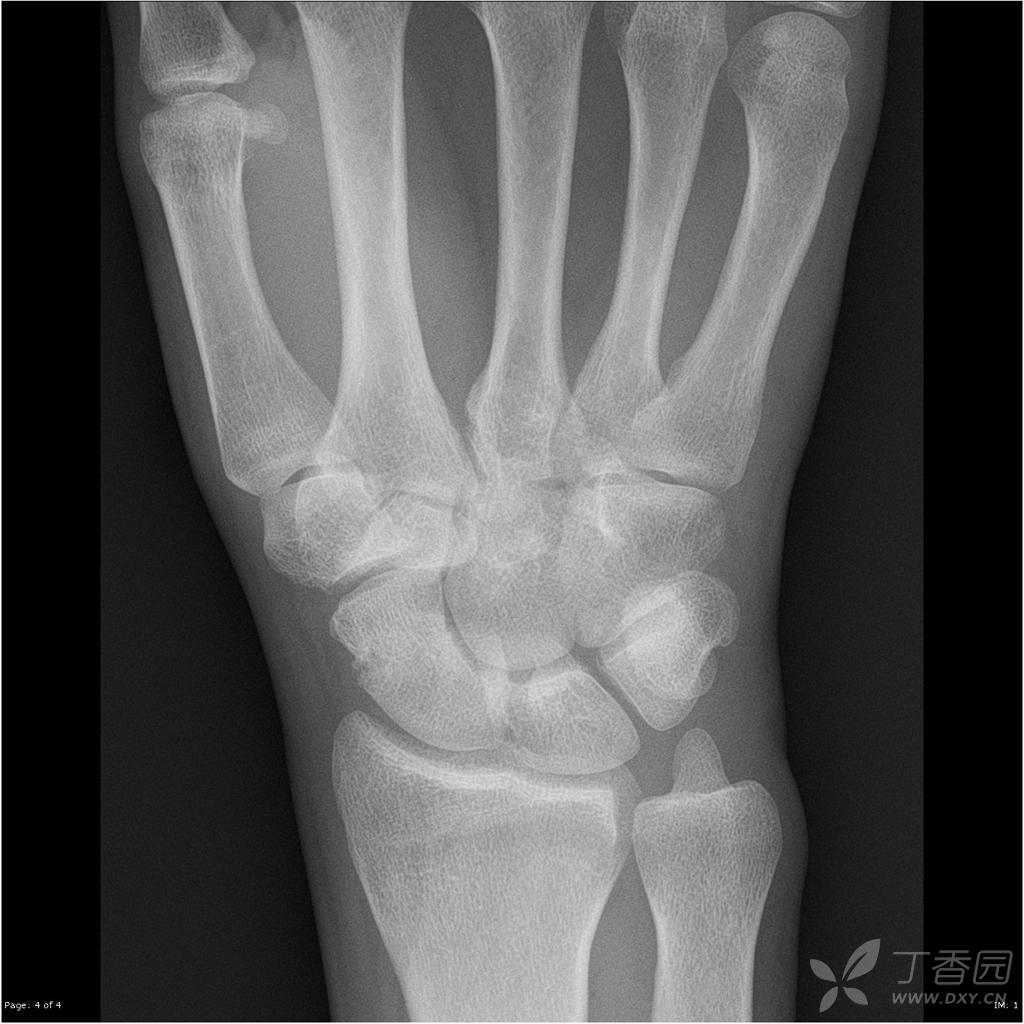 疼痛影像二三事系列之六---腕关节部分(优质回帖有礼)