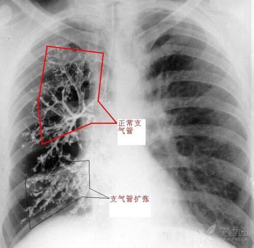支气管扩张胸片图片图片
