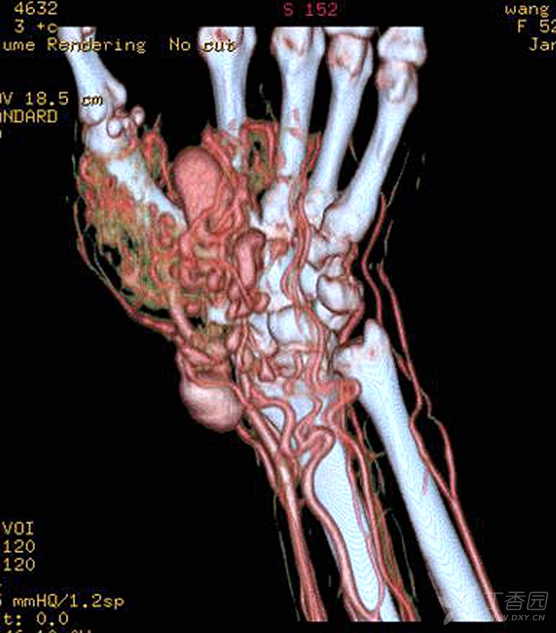 手部软组织血管瘤,msct的cta三维图像可清晰显示迂曲畸形的血管和瘤样