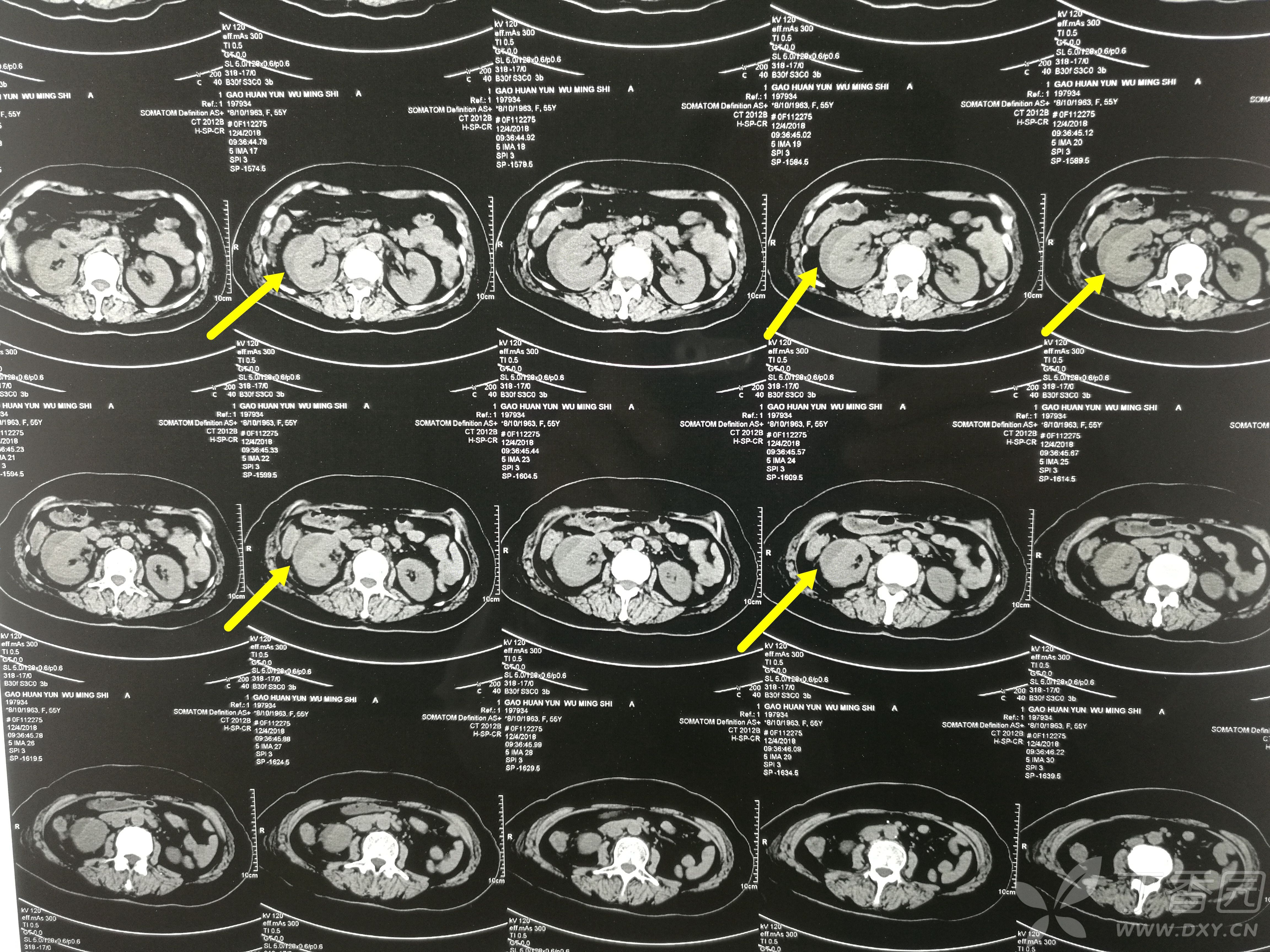 无血尿,入院查ct提示:黄箭头所指为右肾包膜下高密度影,考虑血肿;绿