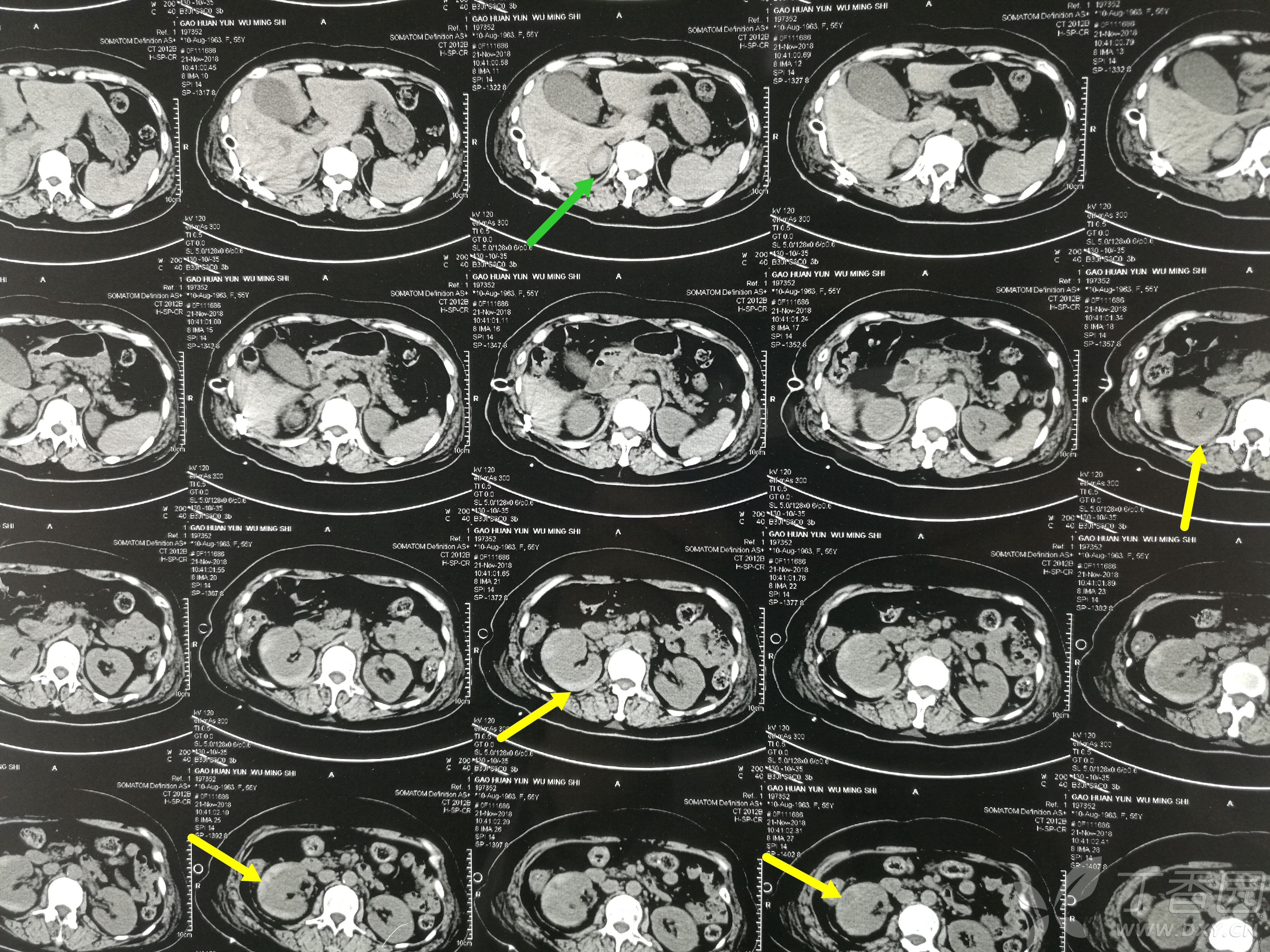 无血尿,入院查ct提示:黄箭头所指为右肾包膜下高密度影,考虑血肿;绿
