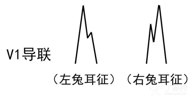 兔耳征.png