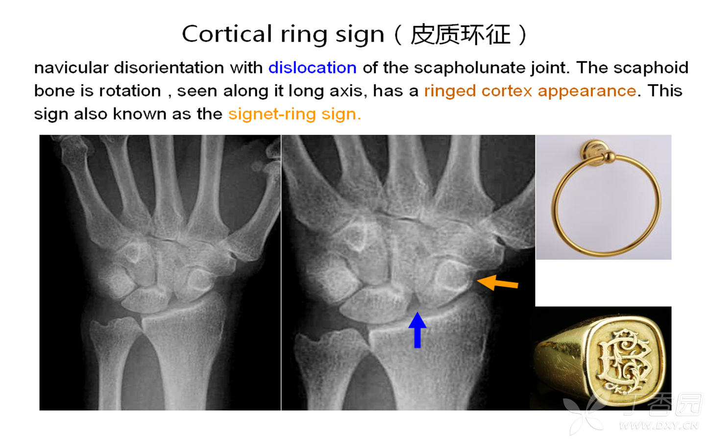 cortical ring sign(皮质环征) [病例帖]