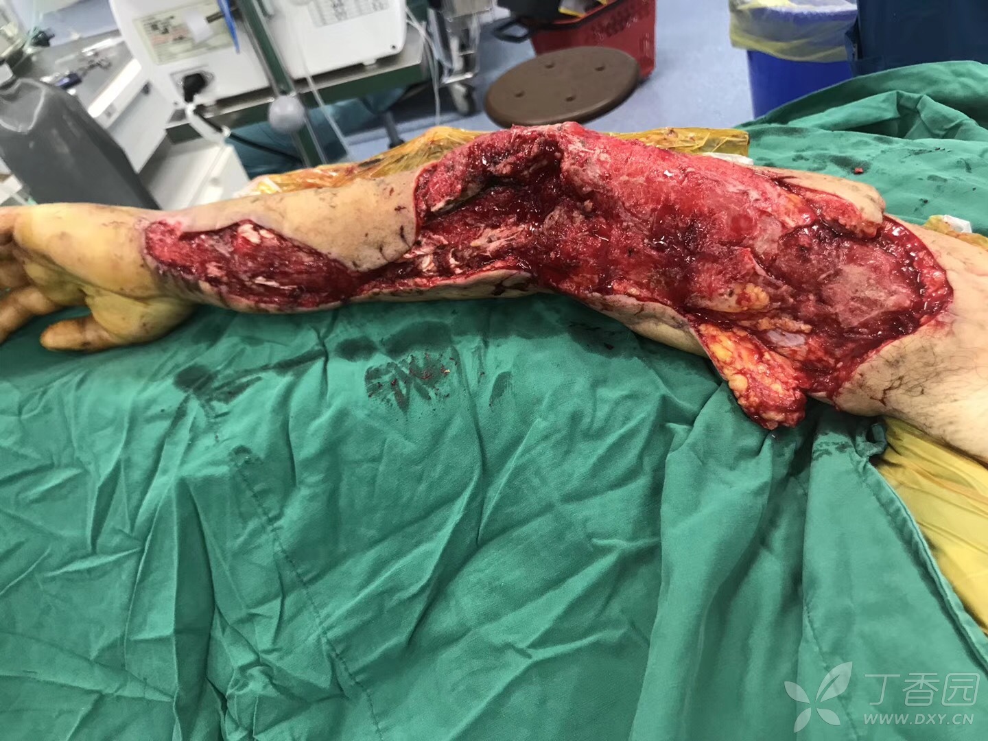 【讨论】手臂创伤伴缺损修复 [病例帖]