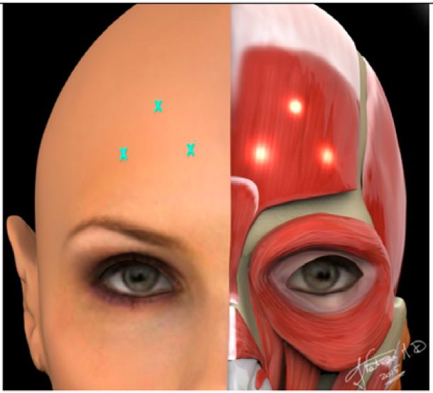 抢先看:2018 肉毒毒素面部美容专家共识(意大利)