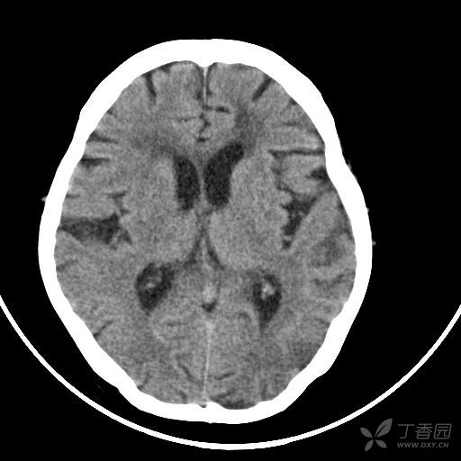 皮质下斑片状低密度灶