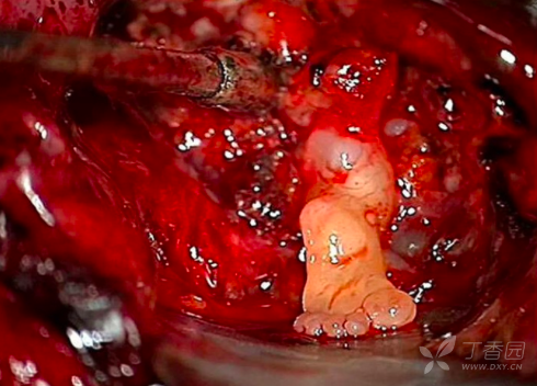 婴儿大脑惊现发育成形的「小脚丫」,畸胎瘤还是寄生胎 ?