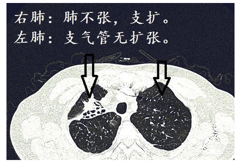 经典图谱,详细解说支气管扩张ct小诀窍:学不会我拜你为师!