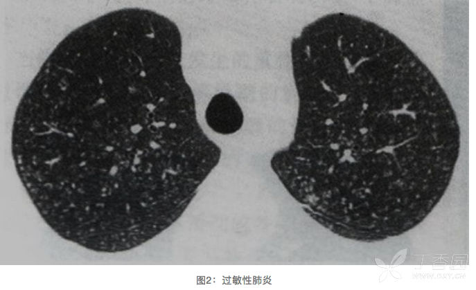 聞襪子得真菌性肺炎?——談談居住環境與肺病! [病例帖]