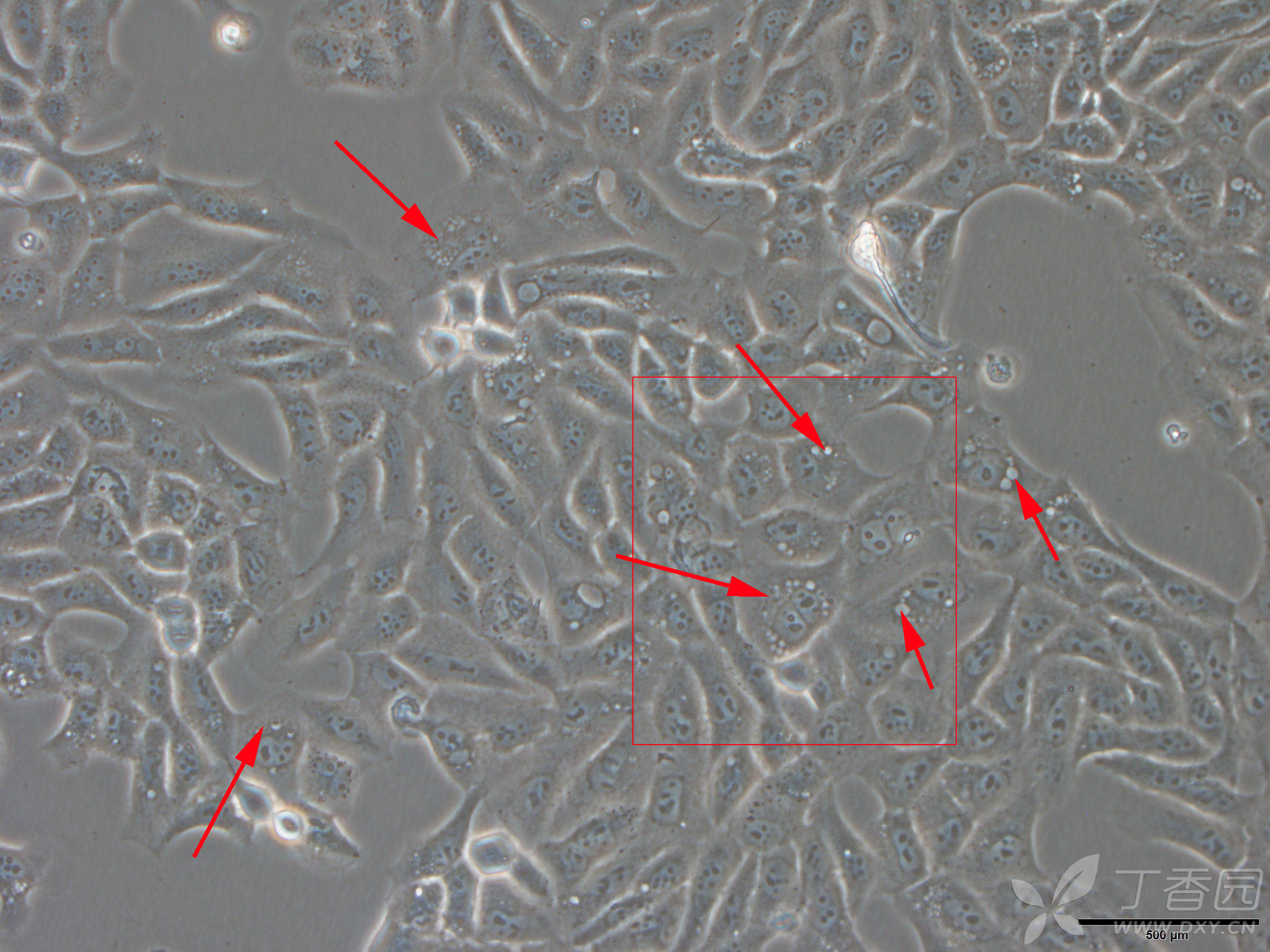 肿瘤细胞系胞质内出现大量空泡原因?