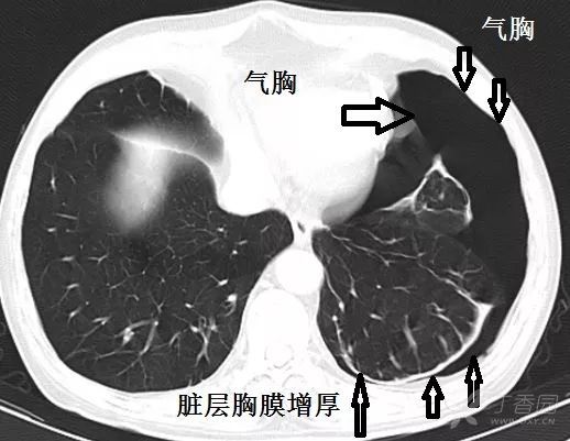 中叶支气管层面,气胸增多.