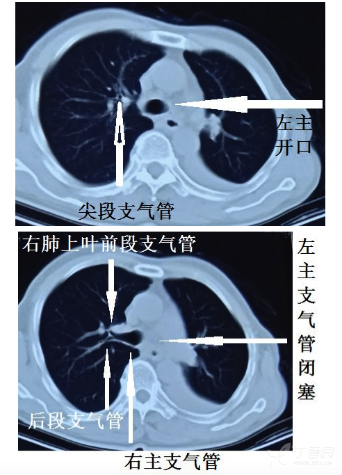 肺窗示图片