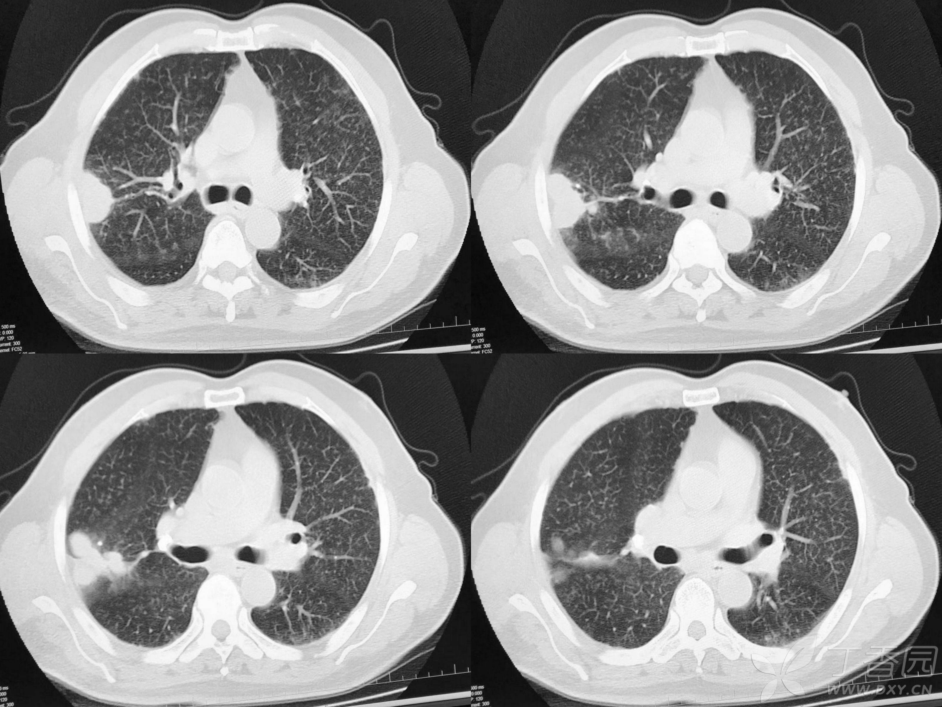 肺部占位ct图片图片