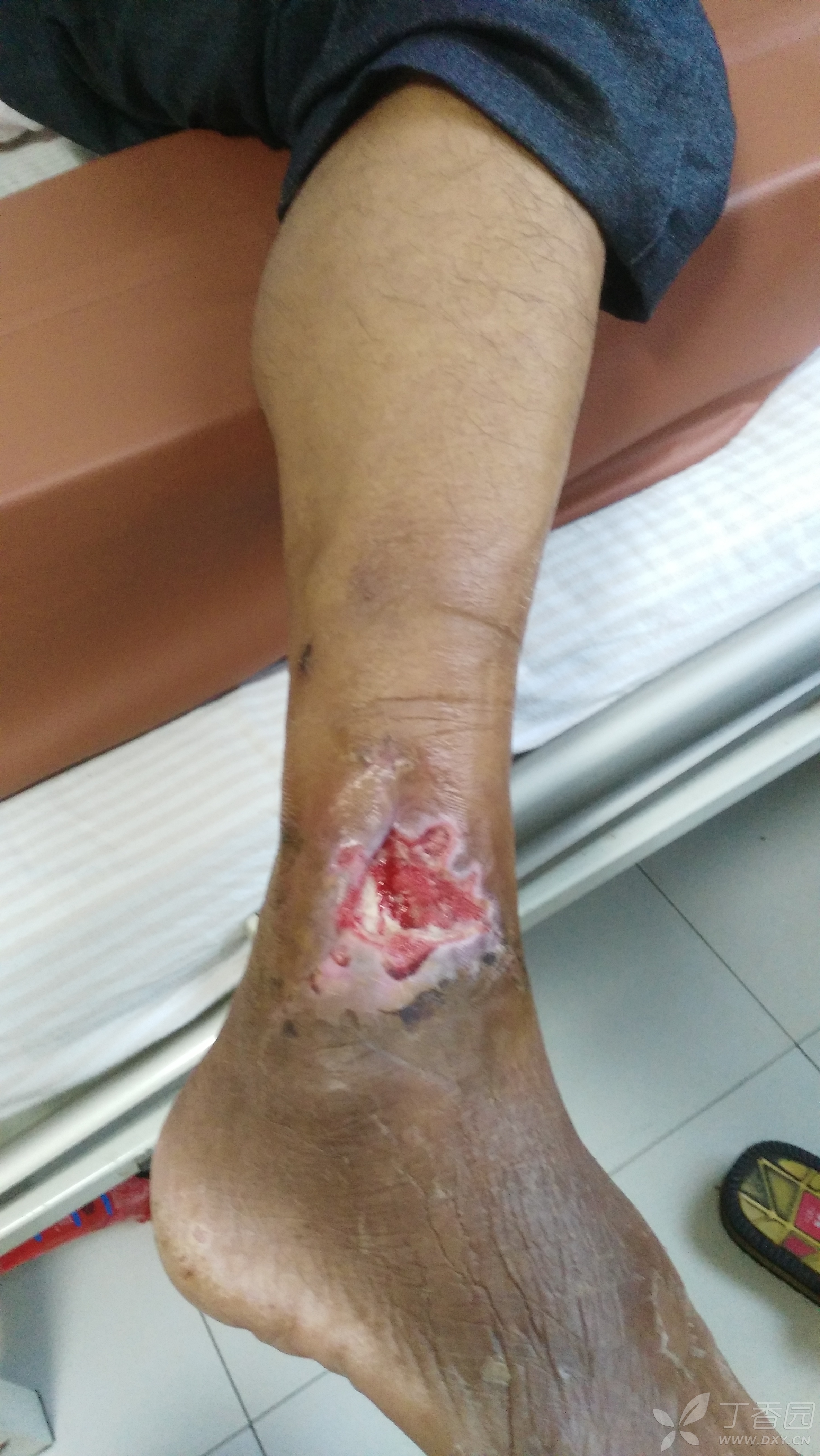 右外踝上外伤术后皮肤坏死2周余,外踝上皮瓣覆盖