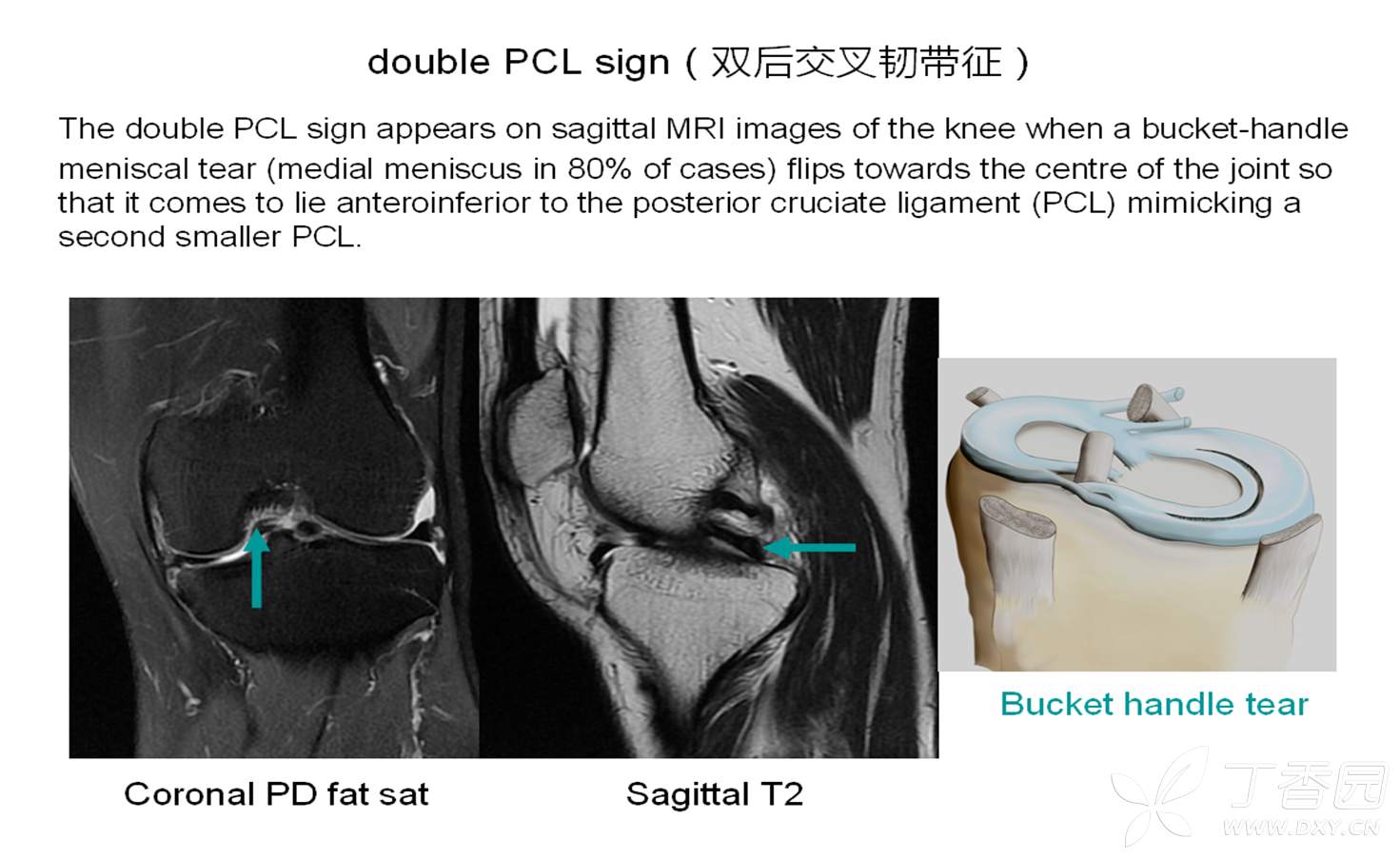 double PCL sign（双后交叉韧带征） - 丁香园论坛