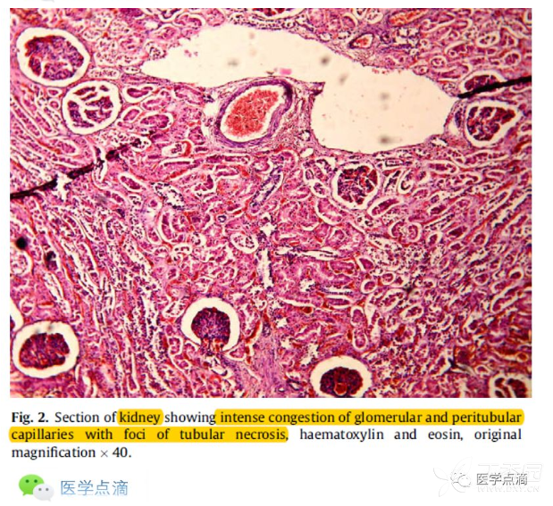 这些死亡通常表现为不可逆的肺水肿和急性肾衰竭.尸检