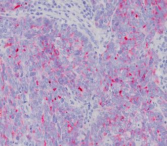 中杉金桥ZM-0019CA125(Ovary) 小鼠抗人卵巢癌相关抗原（CA125）单克隆抗体 Mouse anti-CA125 Monoclonal Antibody  (Ovarian Cancer Antigen)