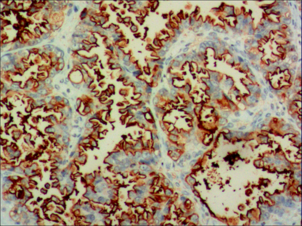 中杉金桥ZM-0020CA15-3 小鼠抗人乳腺癌相关抗原（CA15-3）单克隆抗体 Mouse anti-CA15-3 Antigen Monoclonal Antibody