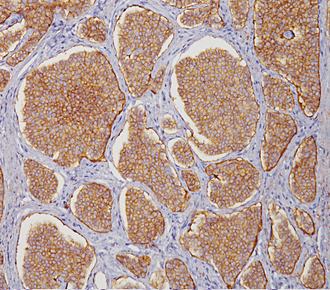 中杉金桥ZM-0057CD56(SCLC) 小鼠抗人CD56单克隆抗体 Mouse anti-CD56（NCAM）Monoclonal Antibody
