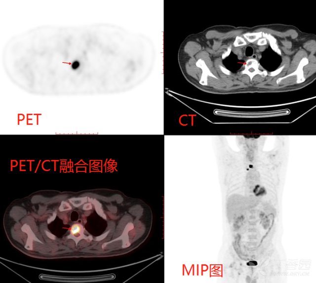 看图学PET/CT--浅谈PET/CT的应用 - 影像医学和核医学讨论版 -丁香园论坛