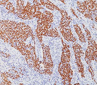 中杉金桥ZM-0269WT1 小鼠抗人WT1单克隆抗体 Mouse anti-WT1 Monoclonal Antibody  （Wilm’s Tumor）