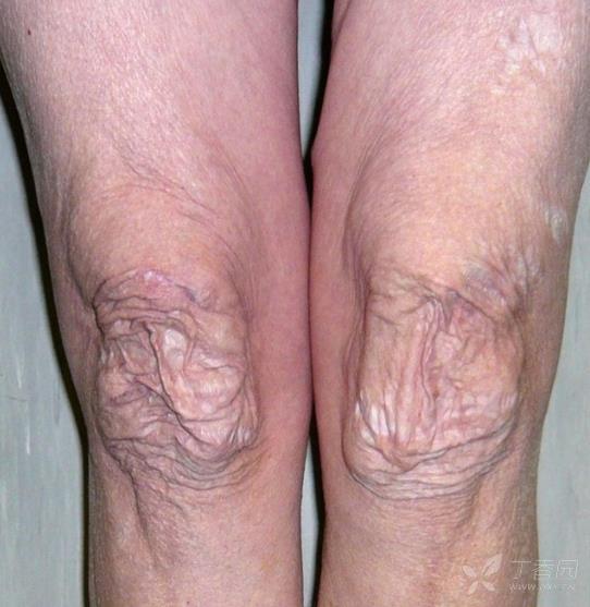 征,正常人群中约10%可以做到,ehlers-danlos综合征患者约50%都能做到