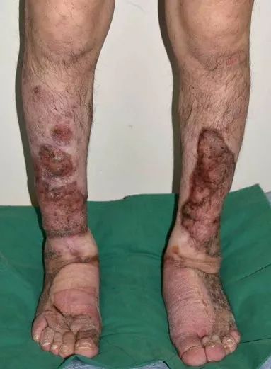 但水肿和结节显著消退病例学习橡皮肿(elephantiasis)描述了皮肤及皮