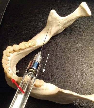 下牙槽静脉图片