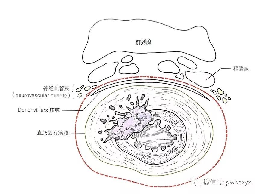 当超声刀遇上精囊腺 男性病人直肠前壁游离技巧