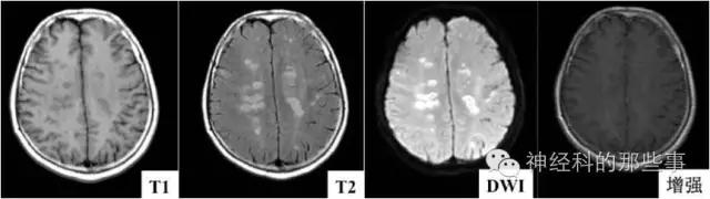病例分析 急性播散性脑脊髓炎 Adem