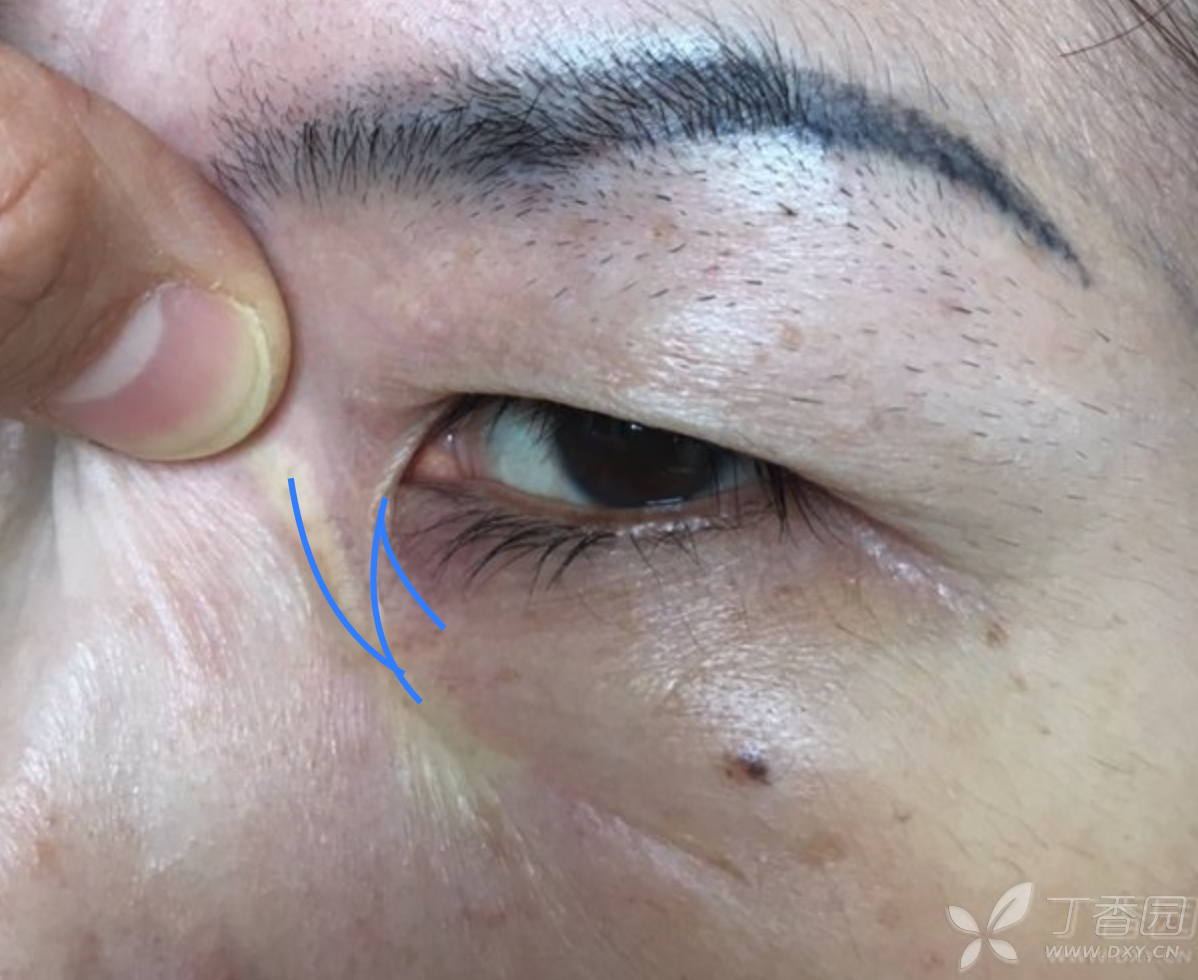 【讨论】内眦蹼状瘢痕求指导