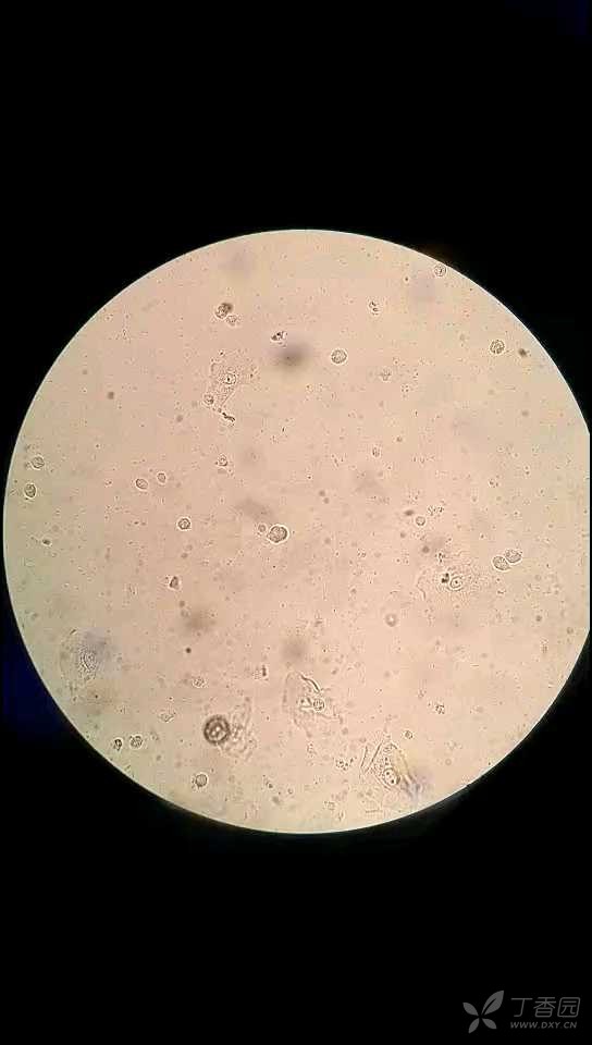 白带滴虫显微镜图片