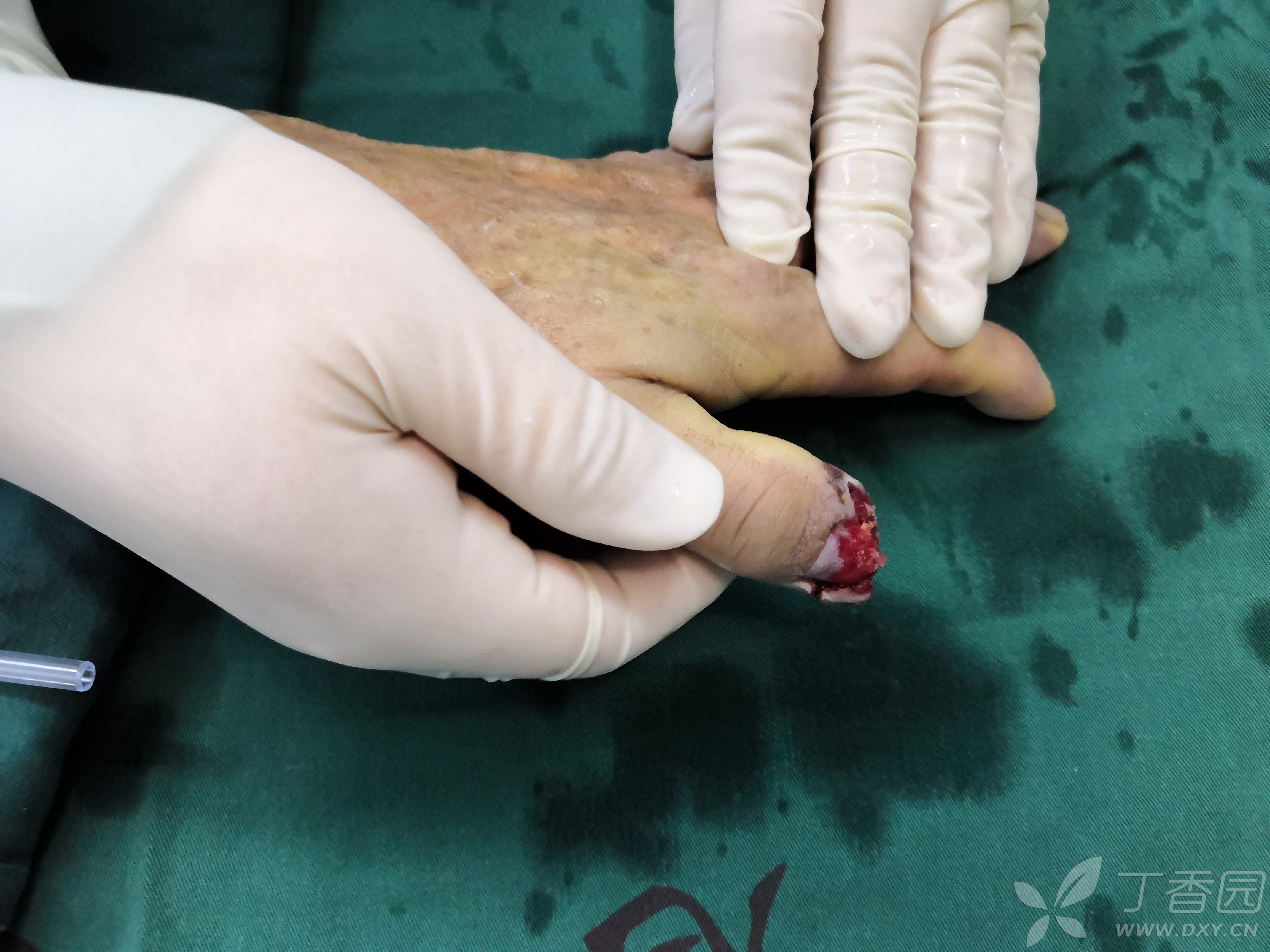 第一次做皮瓣(拇指尺侧皮瓣),请多指教.