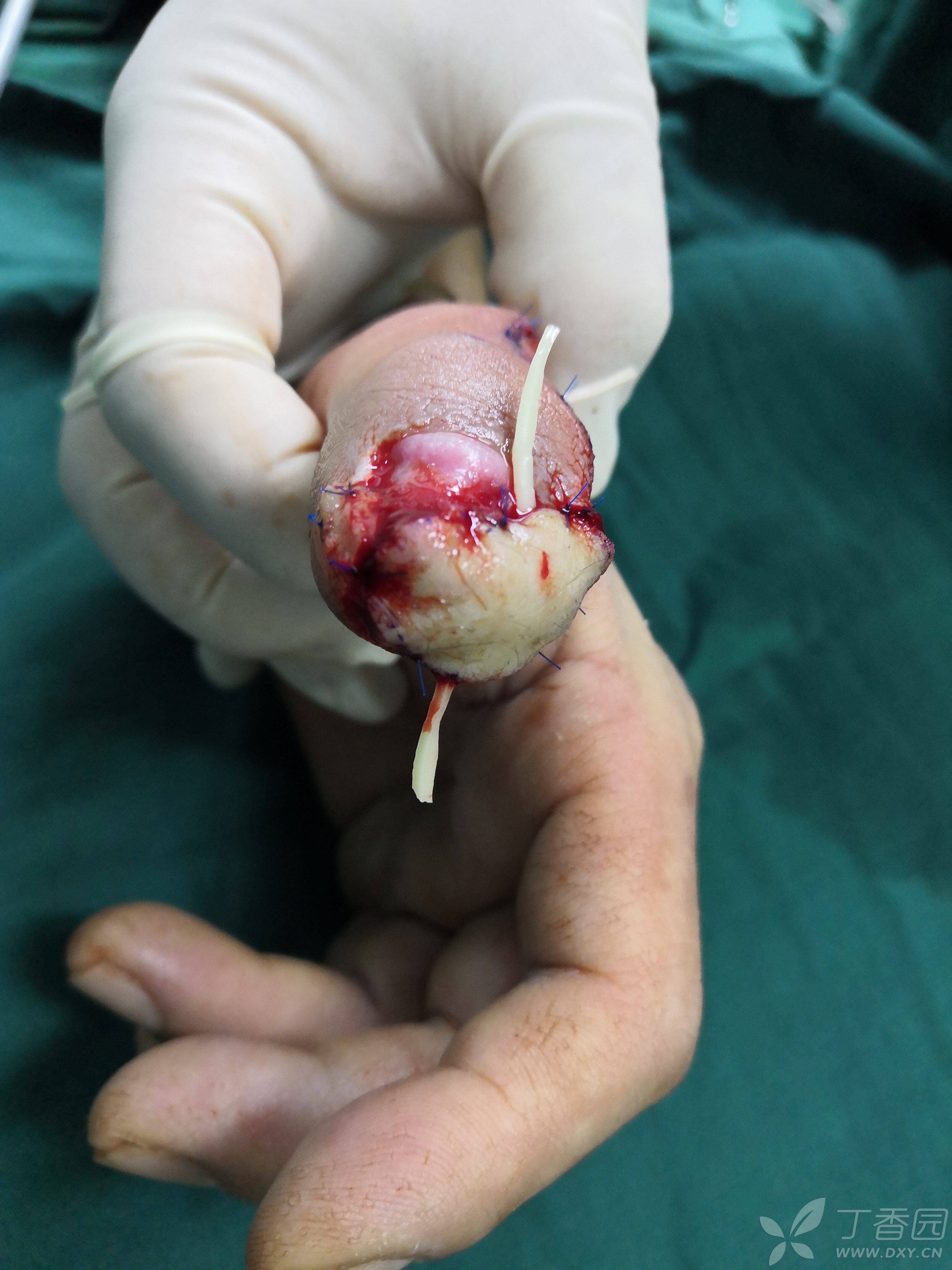 第一次做皮瓣(拇指尺侧皮瓣),请多指教.