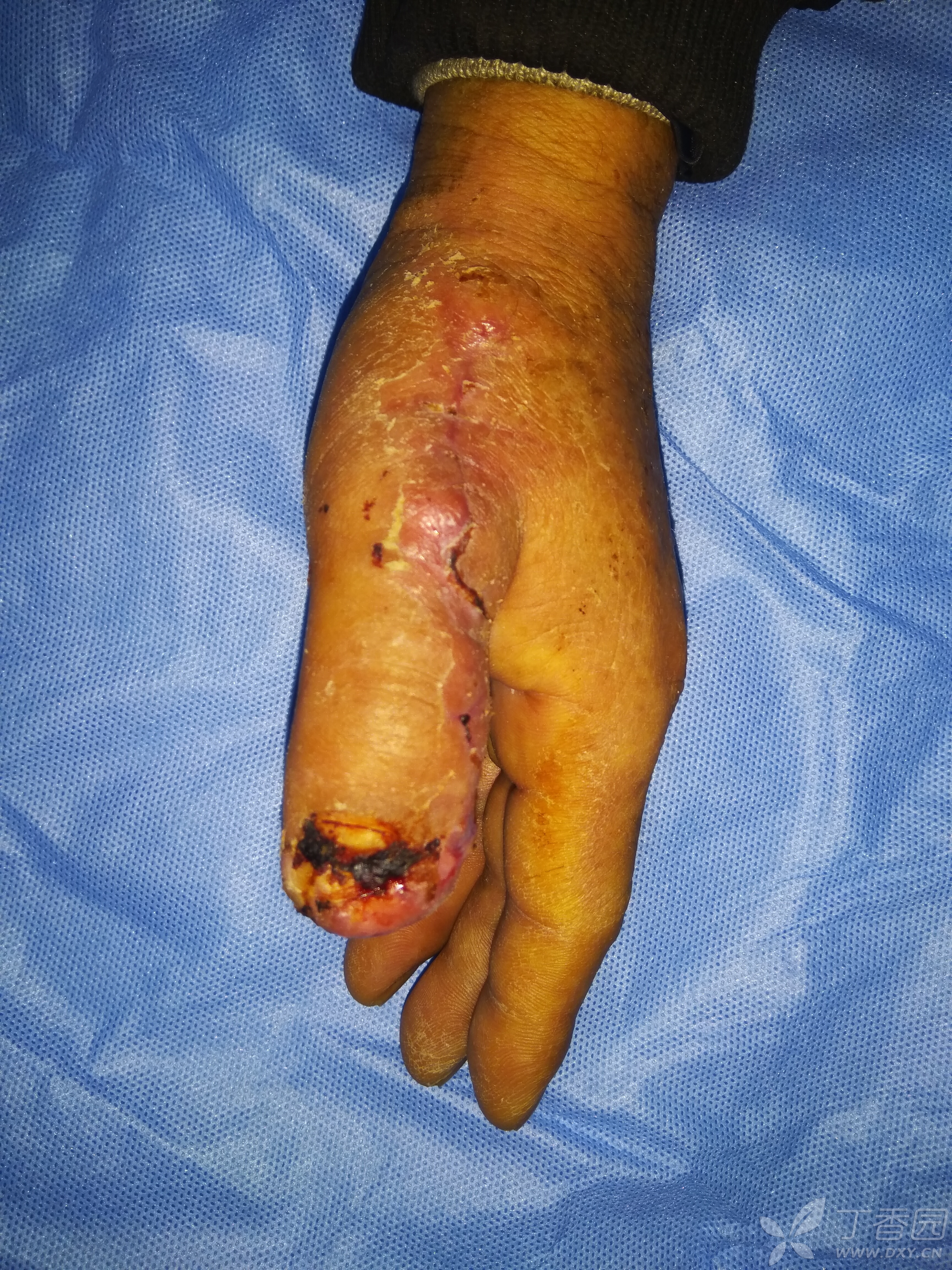 第一次做皮瓣(拇指尺侧皮瓣),请多指教.