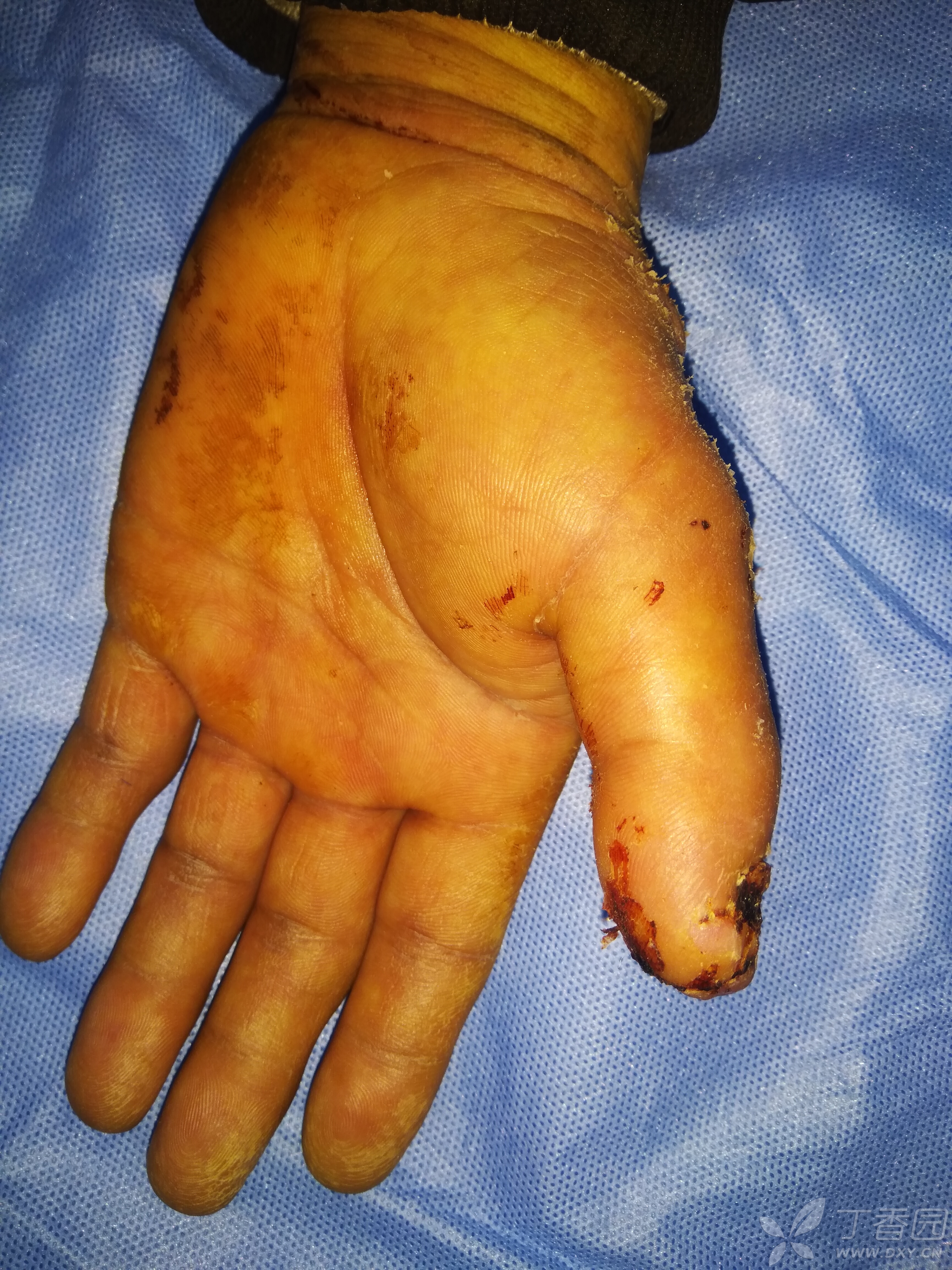 第一次做皮瓣(拇指尺侧皮瓣),请多指教.