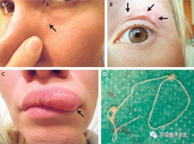 左眼下方的一个结节,5天后自己就移动到左眼上方,10天后有移动到上唇