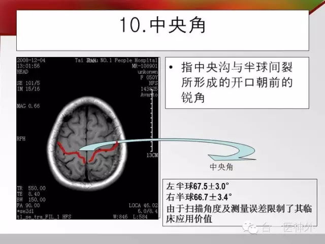 如何在 CT 及 MRI 图像上辨识脑沟回