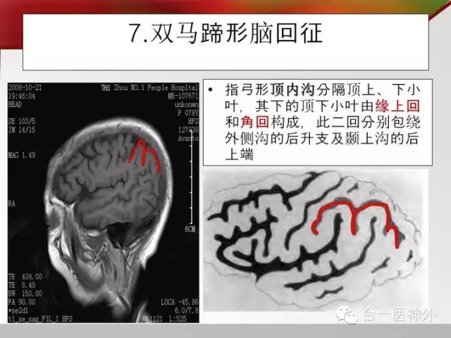 如何在 CT 及 MRI 图像上辨识脑沟回