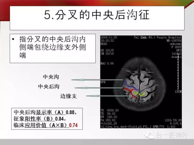 如何在 CT 及 MRI 图像上辨识脑沟回