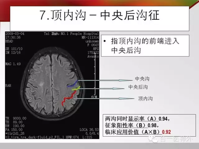 如何在 CT 及 MRI 图像上辨识脑沟回