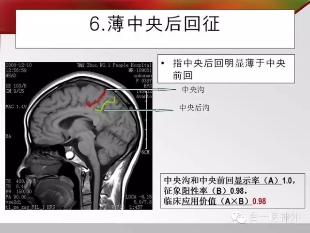 如何在 CT 及 MRI 图像上辨识脑沟回