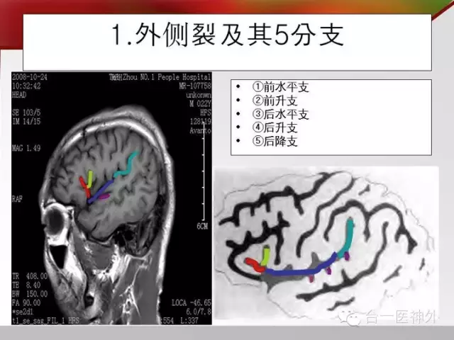 如何在 CT 及 MRI 图像上辨识脑沟回