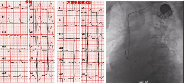 左束支起搏—价廉,高效的心衰治疗利器